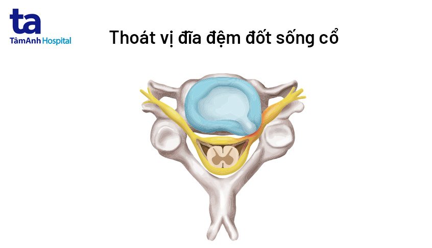 tình trạng thoát vị đĩa đệm đốt sống cổ