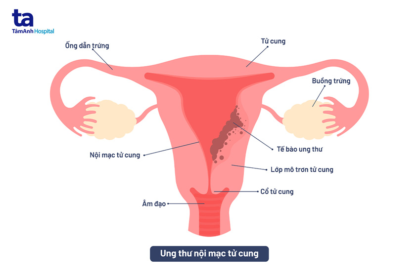 ung thư nội mạc tử cung
