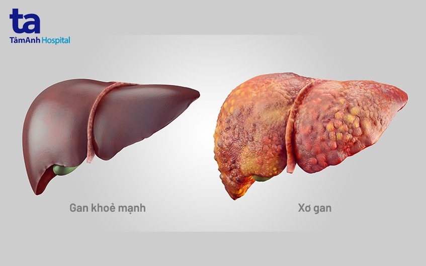 xơ gan giai đoạn mất bù