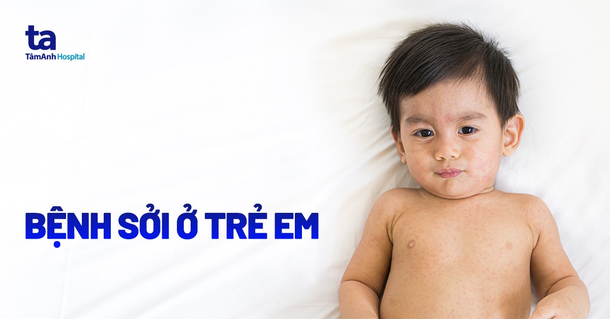 Bệnh sởi ở trẻ em: Nguyên nhân, biến chứng và cách chẩn đoán