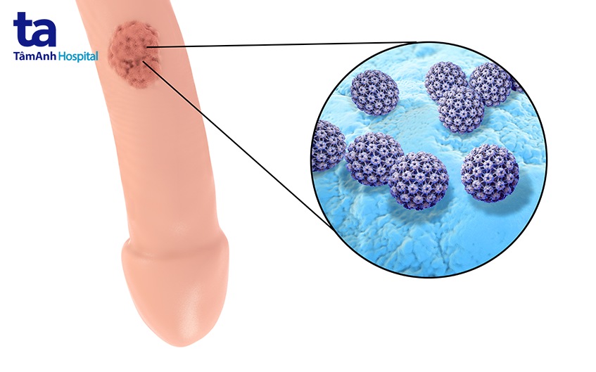bệnh sùi mào gà có nguy hiểm không