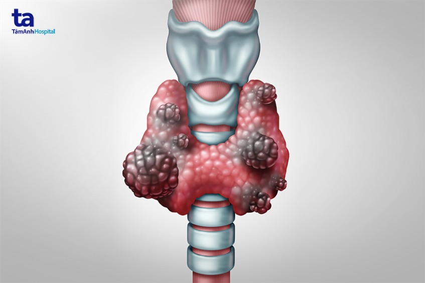 Bướu cổ thường gặp ở nữ hơn nam