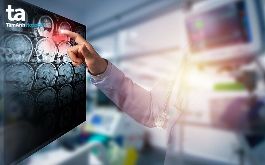 chẩn đoán điều trị tai biến mạch máu não
