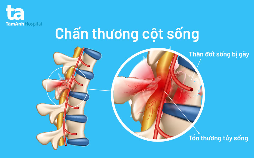 cột sống bị tổn thương
