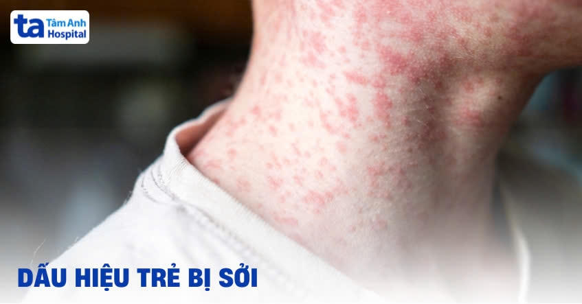 Dấu hiệu trẻ bị sởi cha mẹ nên biết để cứu chữa kịp thời