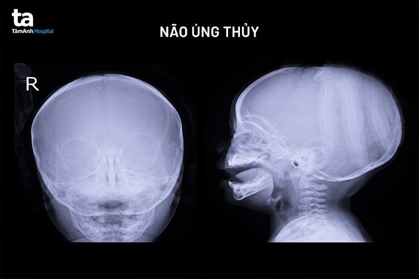 di chứng nguy hiểm do bệnh não úng thủy ở trẻ
