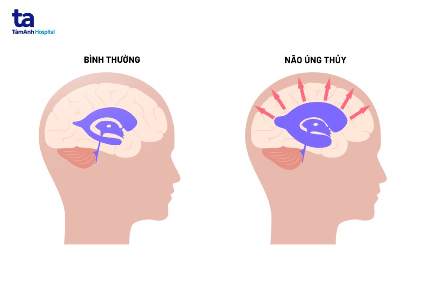 Dịch não tủy tích tụ bên trong não thất làm tăng áp lực lên nội sọ