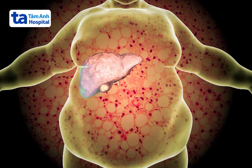 gan nhiễm mỡ cấp độ 2