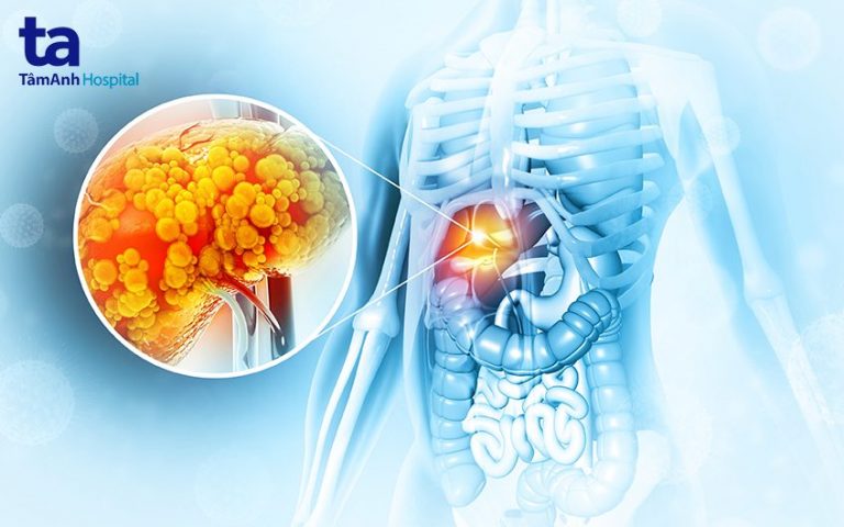 Gan nhiễm mỡ độ 2: Nguyên nhân, triệu chứng và cách điều trị