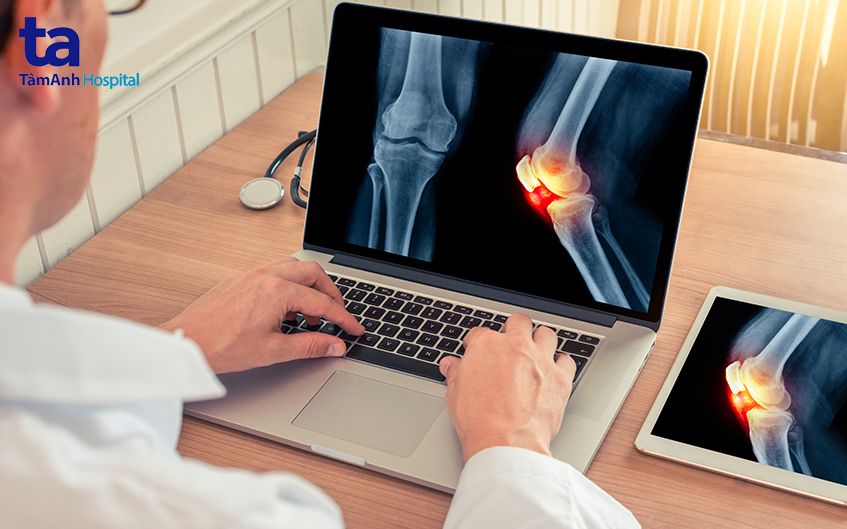 hình ảnh x quang khớp gối bình thường
