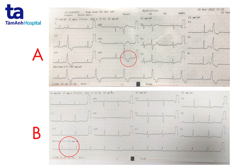 hình ảnh ngoại tâm thu thất nhịp đôi