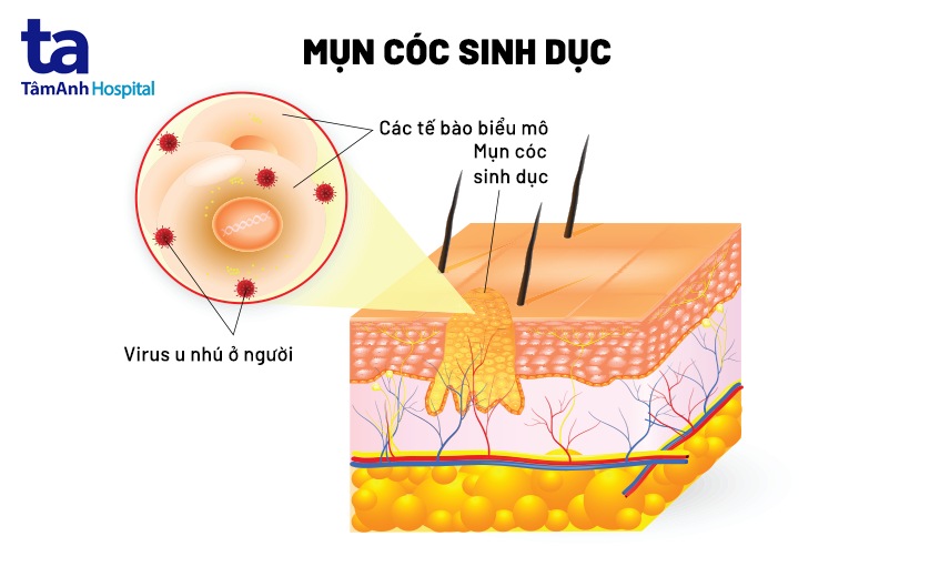 nguyên nhân gây sùi mào gà