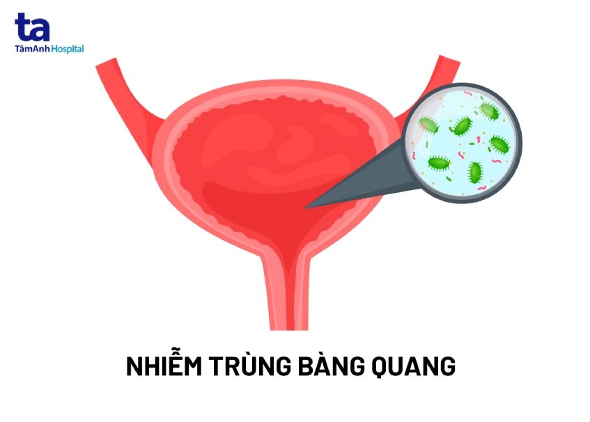 bàng quang nhiễm khuẫn