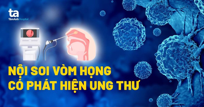 Nội soi vòm họng có đau không? Có phát hiện được ung thư không?