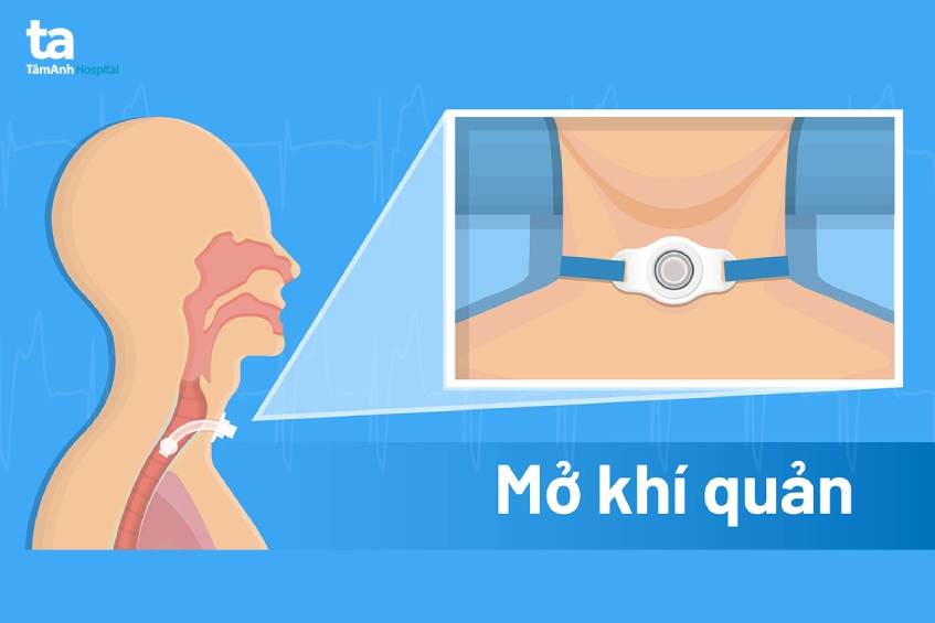 Phẫu thuật mở khí quản