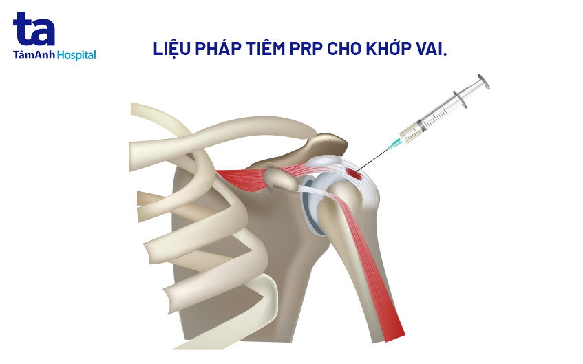 tiêm prp cho khớp vai