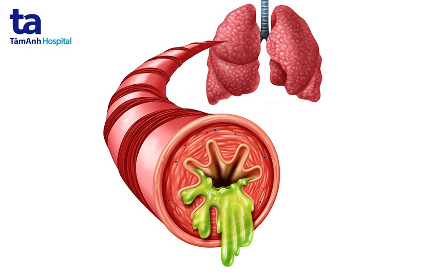 Tiểu phế quản bị sưng, tích tụ dịch nhầy