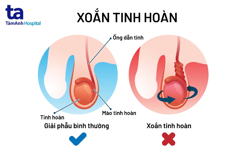 tinh trạng xoắn tinh hoàn