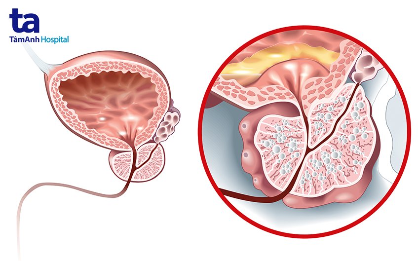 tổng quan về bệnh viêm tuyến tiền liệt