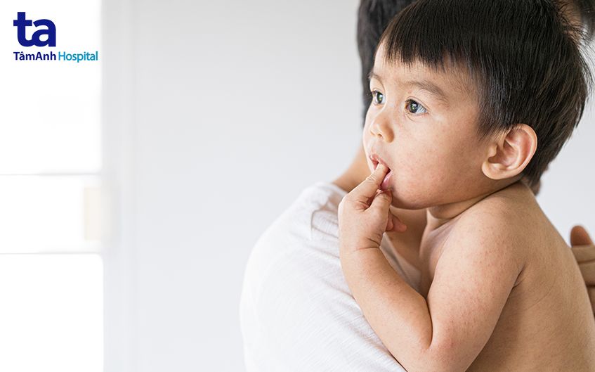 Trẻ bị phát ban toàn thân do sởi