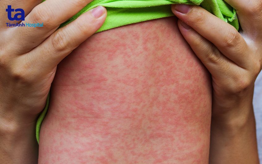 Trẻ phát ban toàn cơ thể do sởi