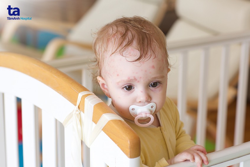 Trẻ xuất hiện nhiều mụn nước trên cơ thể