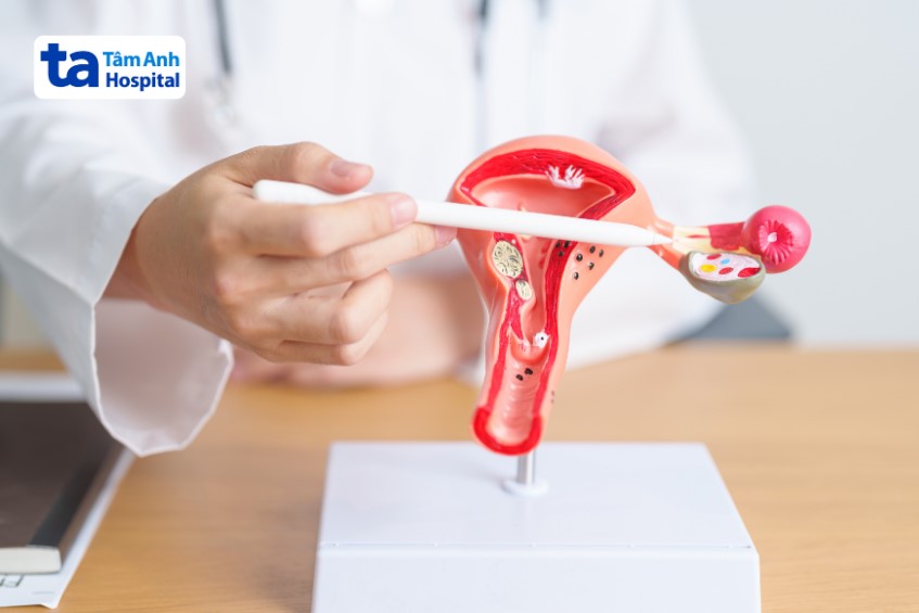 Ung thư buồng trứng