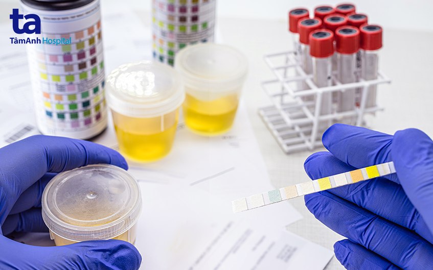 xét nghiệm nước tiểu