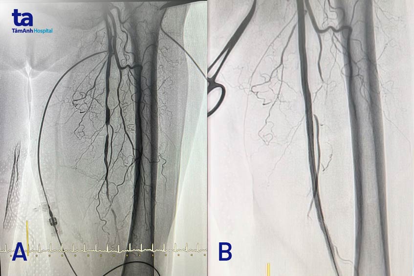 phình động mạch đùi trái