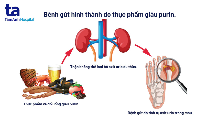 bệnh gút được hình thành