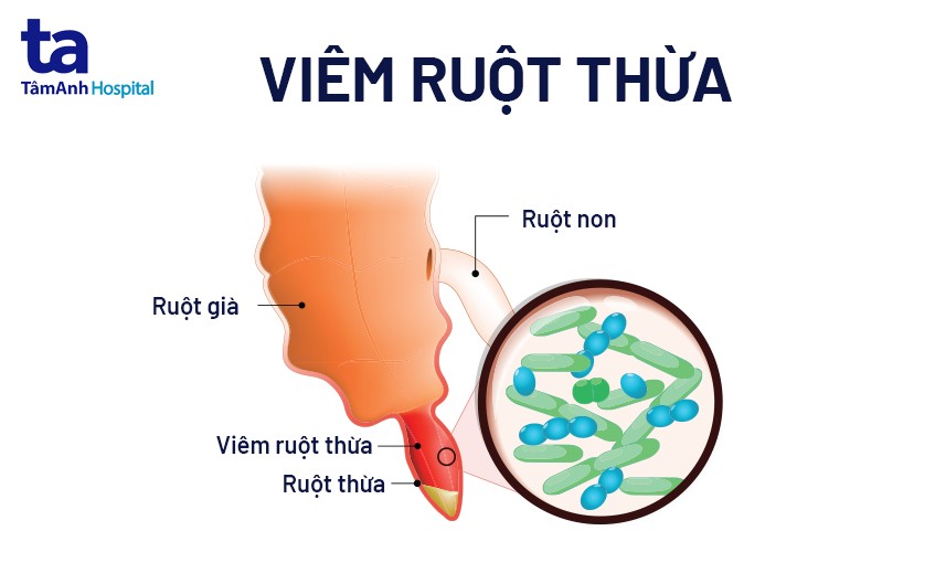 bệnh về ruột thừa