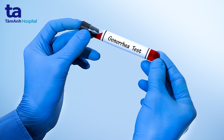 chẩn đoán bệnh lậu