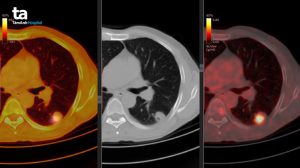 Chụp PET CT: Quy trình, khi nào thực hiện, ứng dụng trong bệnh lý nào?