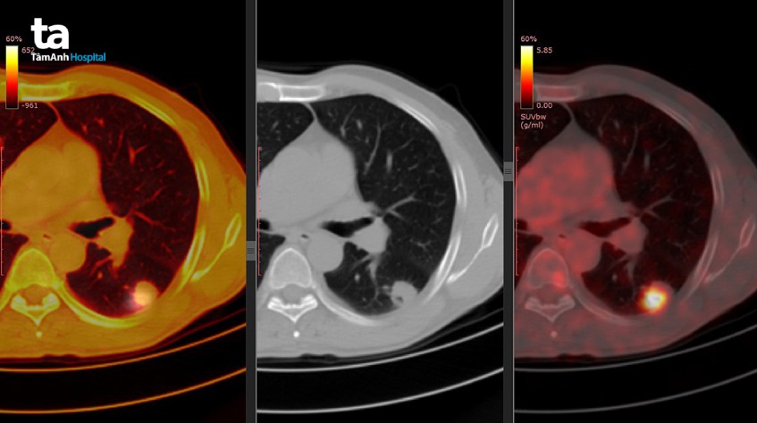 chụp pet/ct để làm gì