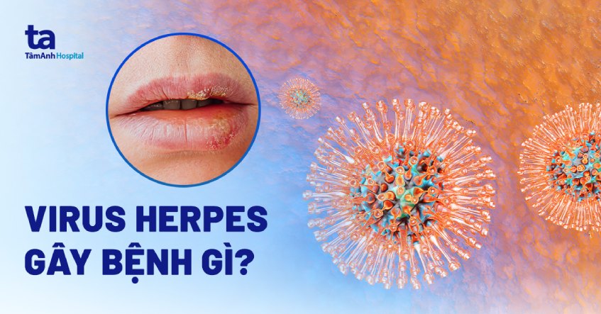 Virus Herpes là gì? Gây ra những bệnh nào? Có nguy hiểm không?
