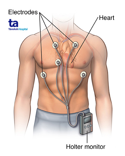 đeo máy holter