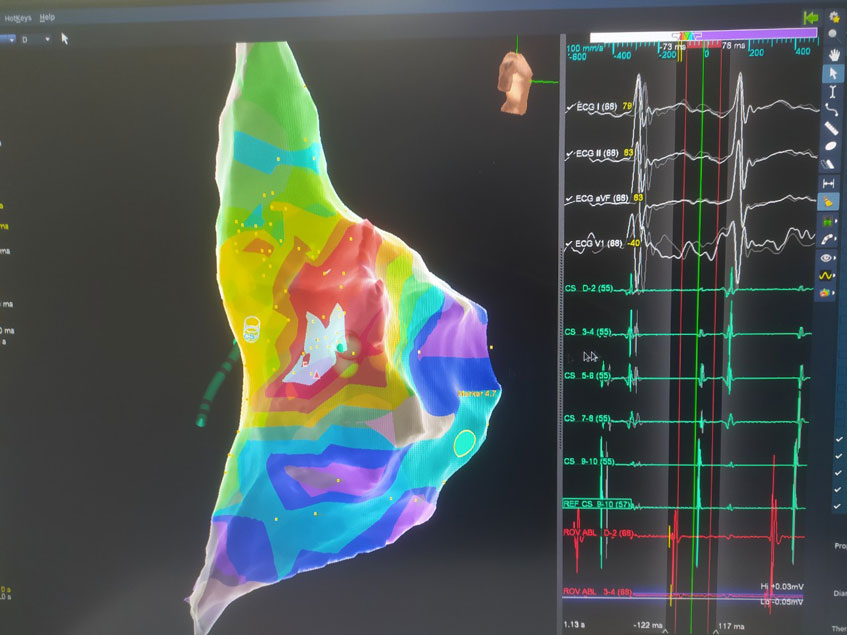 hình ảnh 3d buồng nhĩ phải