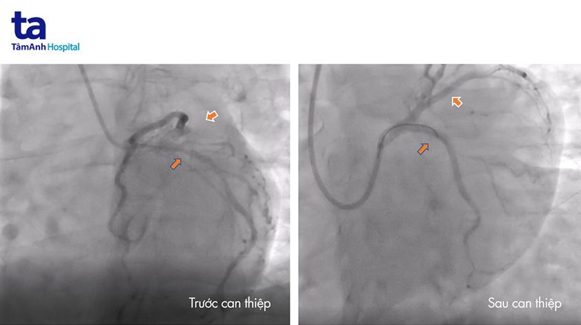 hình ảnh nhánh động mạch