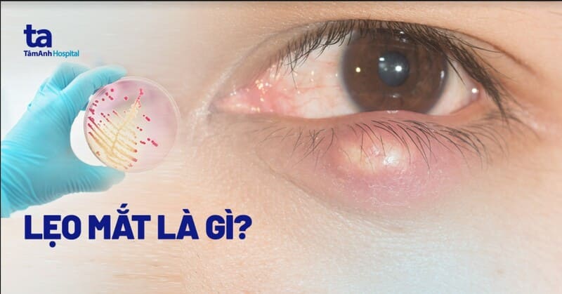 Mụt lẹo mắt: Nguyên nhân, dấu hiệu, chẩn đoán và phòng ngừa