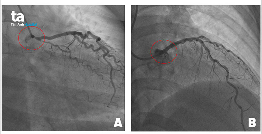 sau khi đặt stent thành công