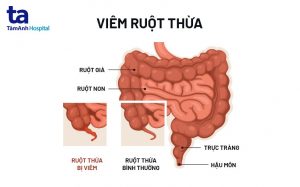 Viêm ruột thừa cấp tính xảy ra do lòng mạch bị tắc nghẽn