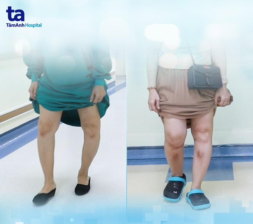 bệnh nhân đi lại bình thường