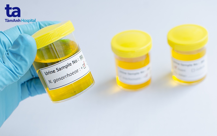 chẩn đoán bệnh lậu ở nam