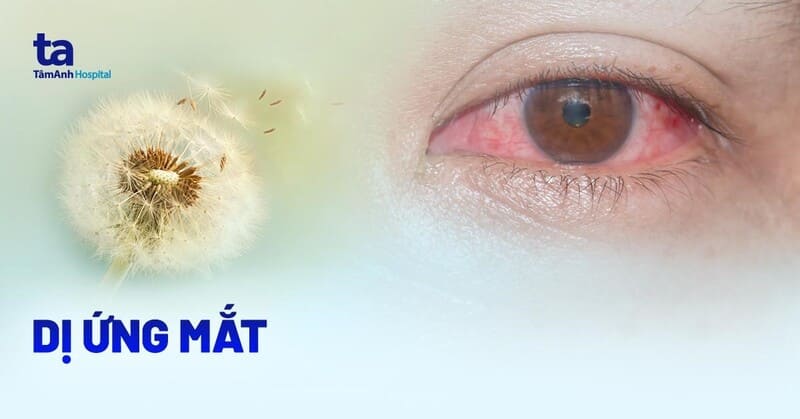 Dị ứng mắt: Nguyên nhân, triệu chứng và phòng ngừa