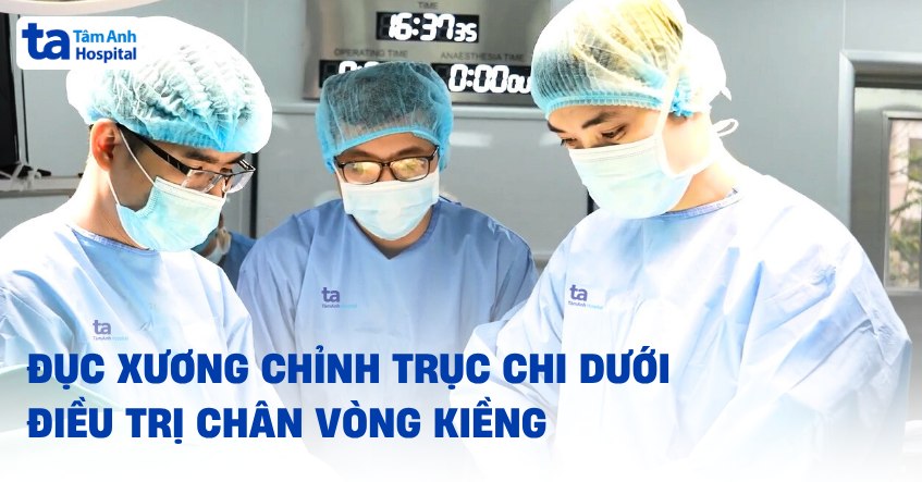 Đục xương chỉnh trục điều trị chân vòng kiềng nặng