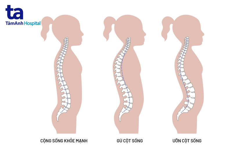 gù cột sống ở trẻ em