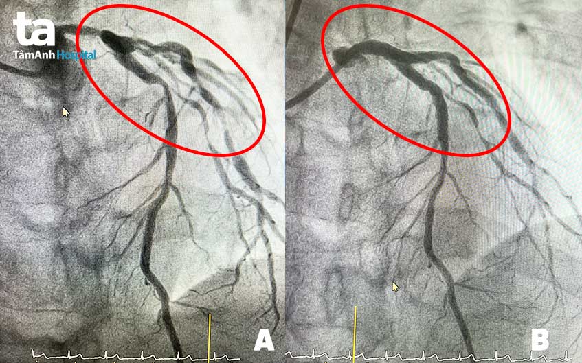 hình ảnh mạch máu bị tắc hẹp