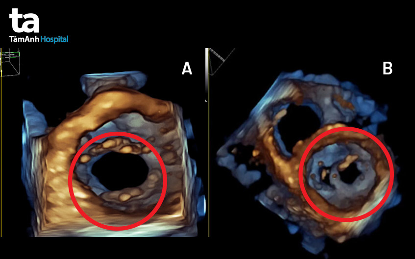 hình ảnh siêu âm tim van 2 lá