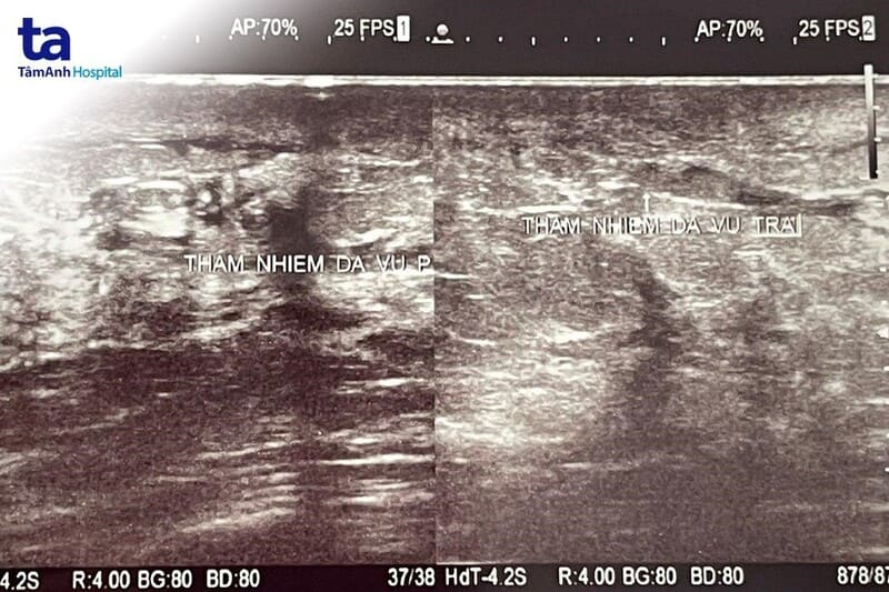 hình ảnh thâm nhiễm da vú