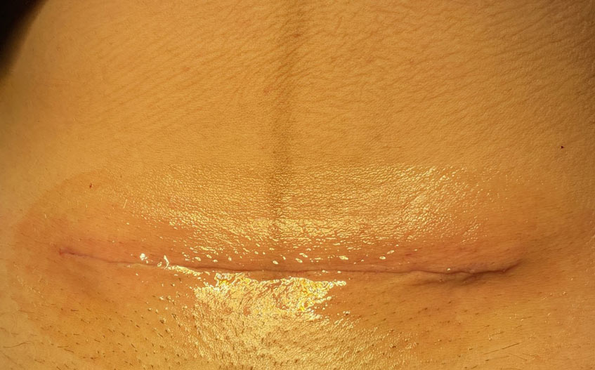 keo dán da sinh học